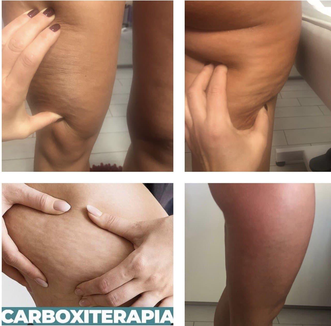 Peeling corpo+carboxyterapia